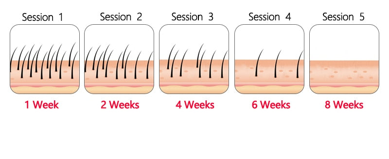 IPL Laser Hair Remover